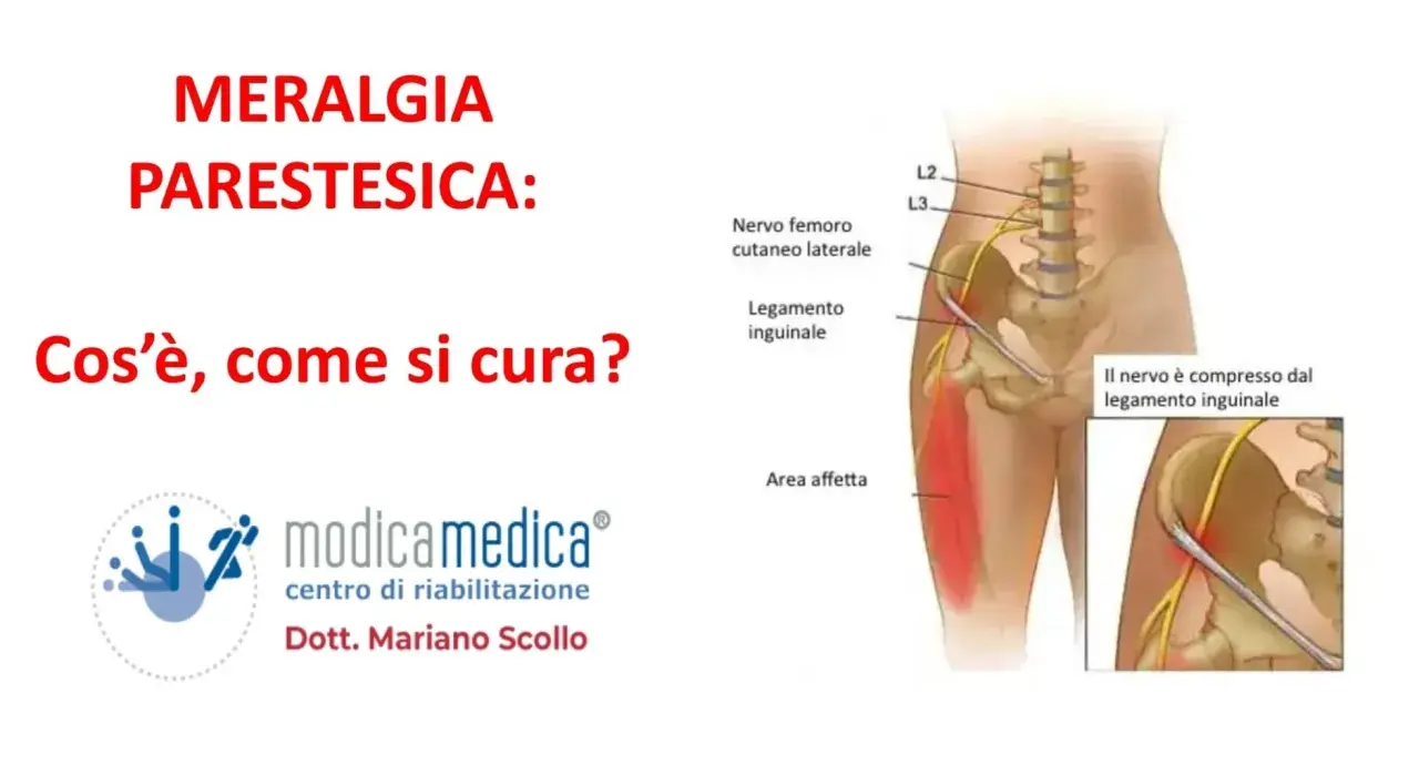 Meralgia parestesica: illustrazione del nervo femorale compresso, con sintomi e area affetta.