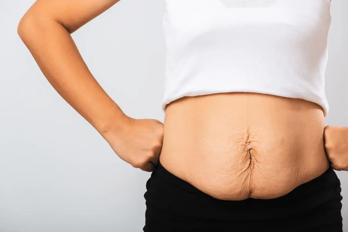 Addome con smagliature e diastasi addominale: cosa fare per recuperare tonicità e benessere.