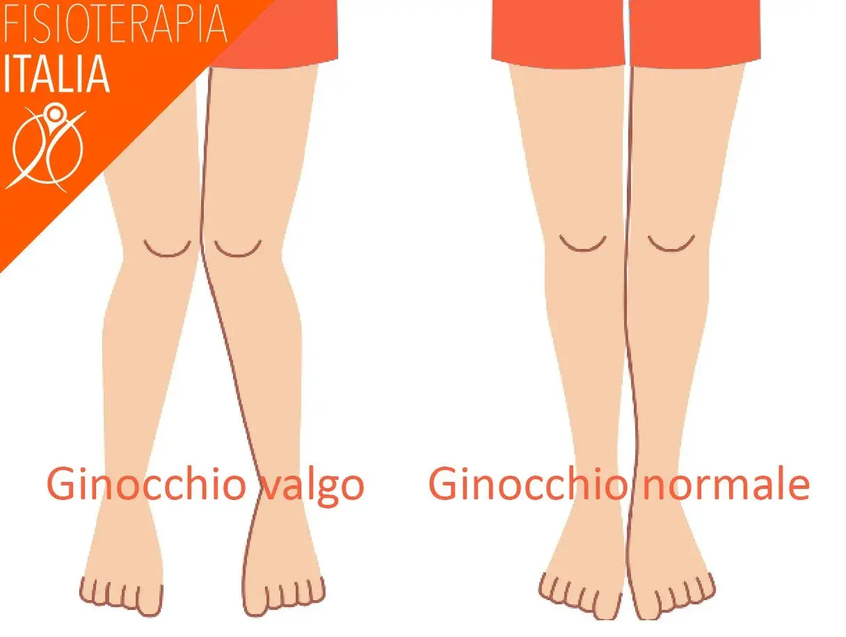 Confronto ginocchio valgo e ginocchio normale, utile per il valgus stress test.