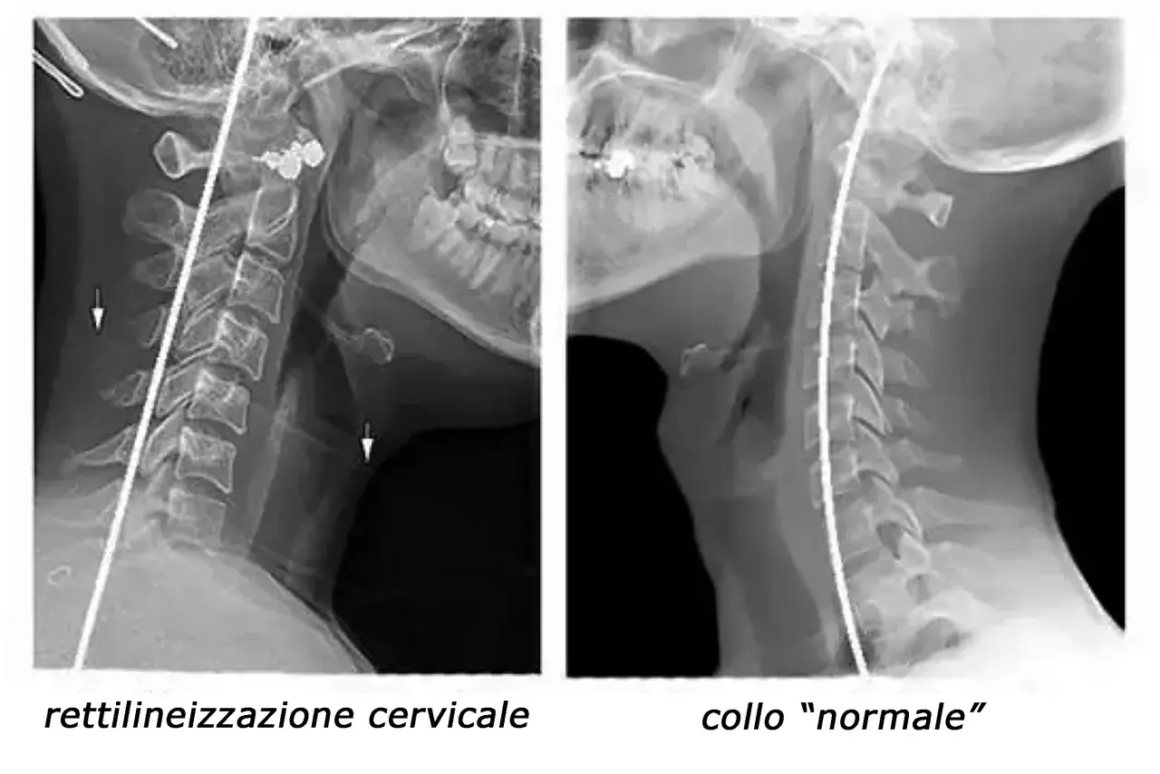 Radiografie del collo: a sinistra, rettilineizzazione cervicale con riduzione della lordosi; a destra, collo "normale".