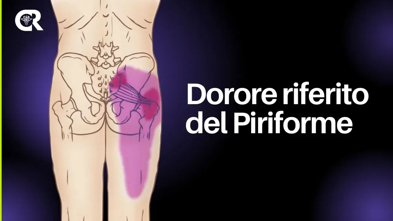 Dolore riferito del piriforme: un'illustrazione anatomica mostra l'area del gluteo e della gamba interessata da infiammazione.