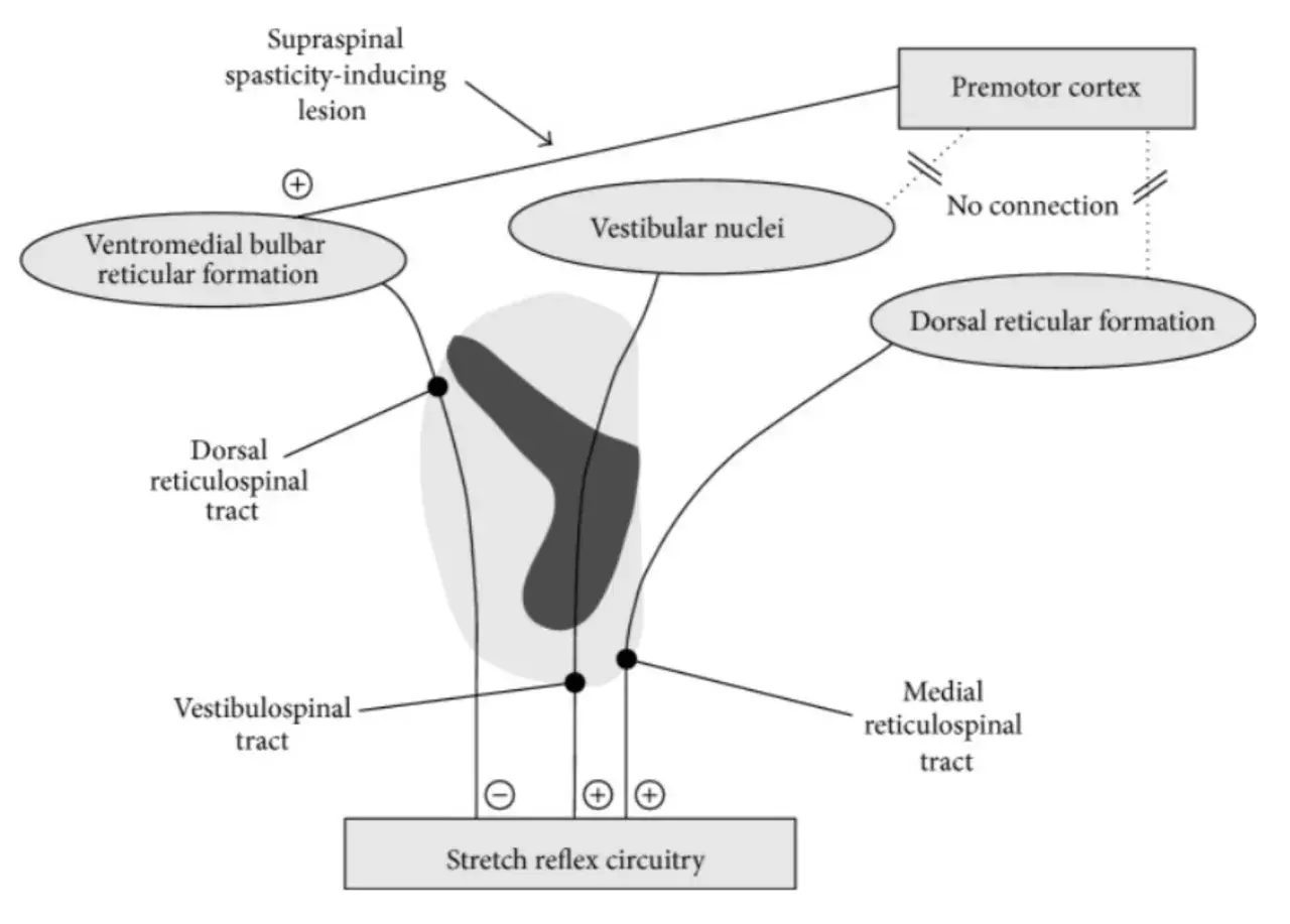Schema che illustra la spasticità indotta da lesioni sovraspinali, con percorsi che influenzano il circuito del riflesso da stiramento, rilevante per la scala Ashworth.