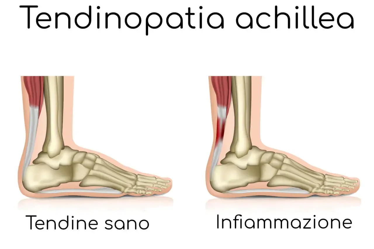Confronto anatomico: tendine d'Achille sano e infiammato, causa di bruciore ai talloni a riposo.