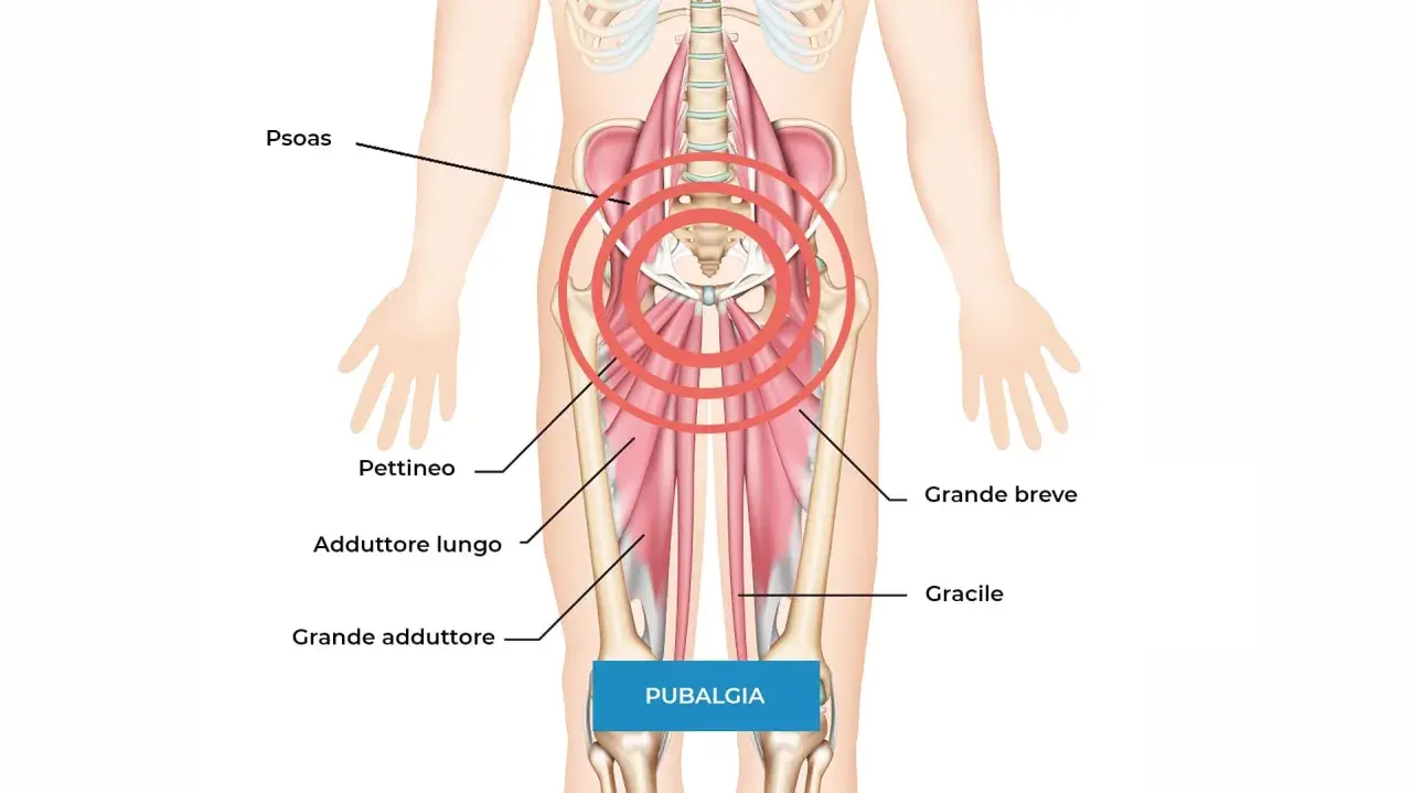 Illustrazione anatomica che mostra i muscoli adduttori e il psoas, aree spesso coinvolte nella pubalgia. Scopri i rimedi.