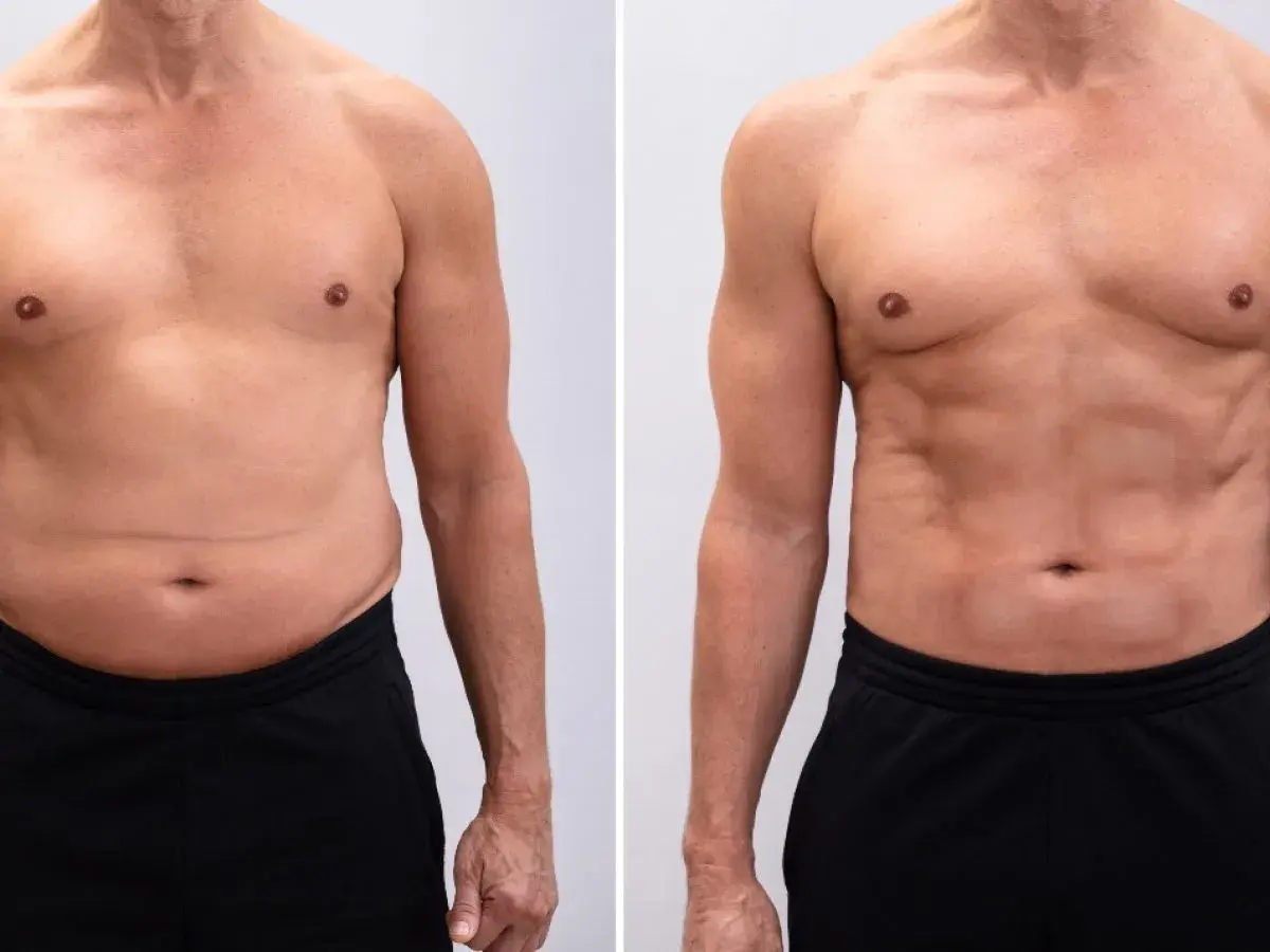 Uomo prima e dopo il trattamento per la diastasi addominale. La pinna addominale è visibilmente ridotta.