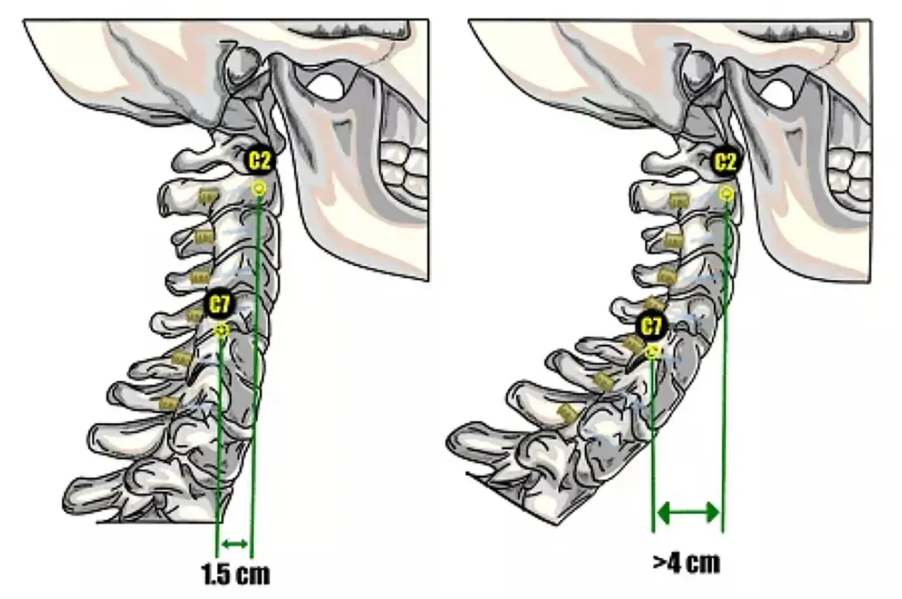 Confronto tra colonna cervicale normale (1.5 cm) e iperlordosi cervicale (>4 cm).