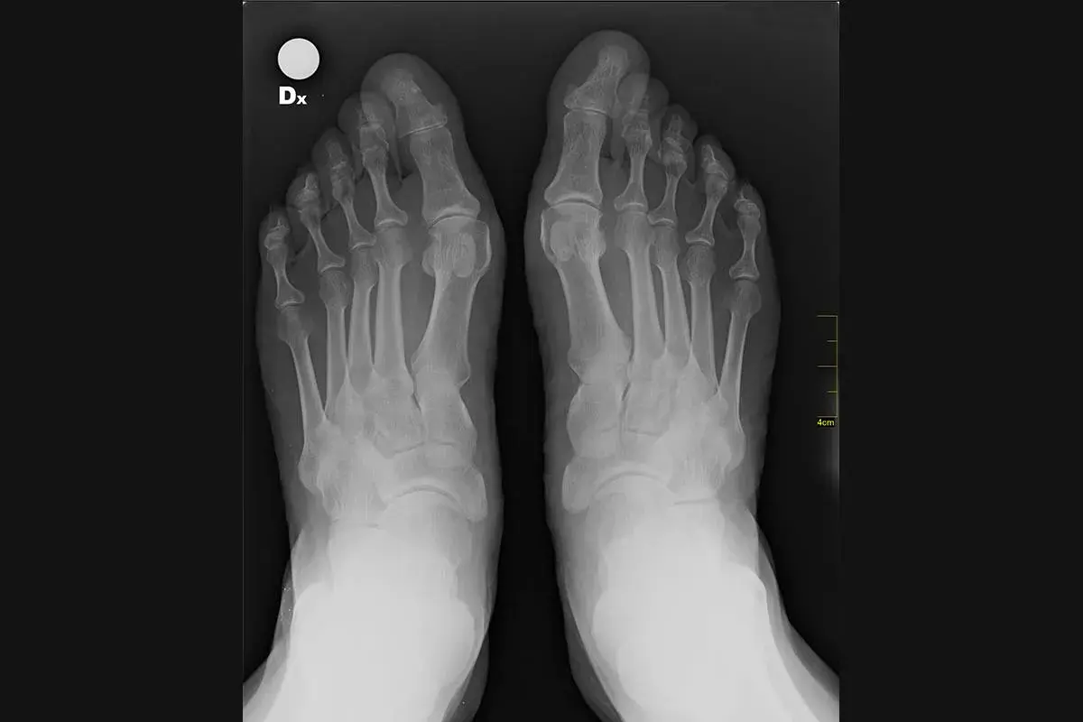 Radiografia dei piedi che mostra un marcato alluce valgo angolo, con deviazione dell'alluce verso le altre dita.