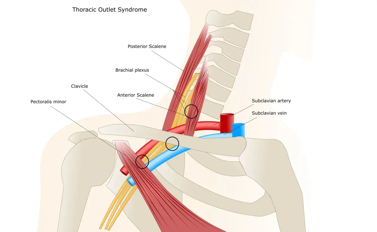 Illustrazione anatomica che mostra le strutture coinvolte nella sindrome dello stretto toracico. Evidenzia la compressione del plesso brachiale e dei vasi sanguigni.