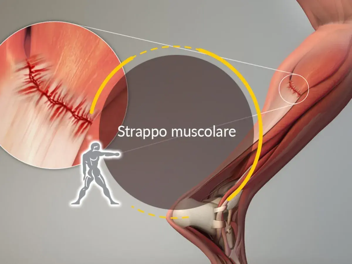 Dettaglio di uno strappo muscolare con suture. L'immagine illustra la lesione e i tempi di recupero.