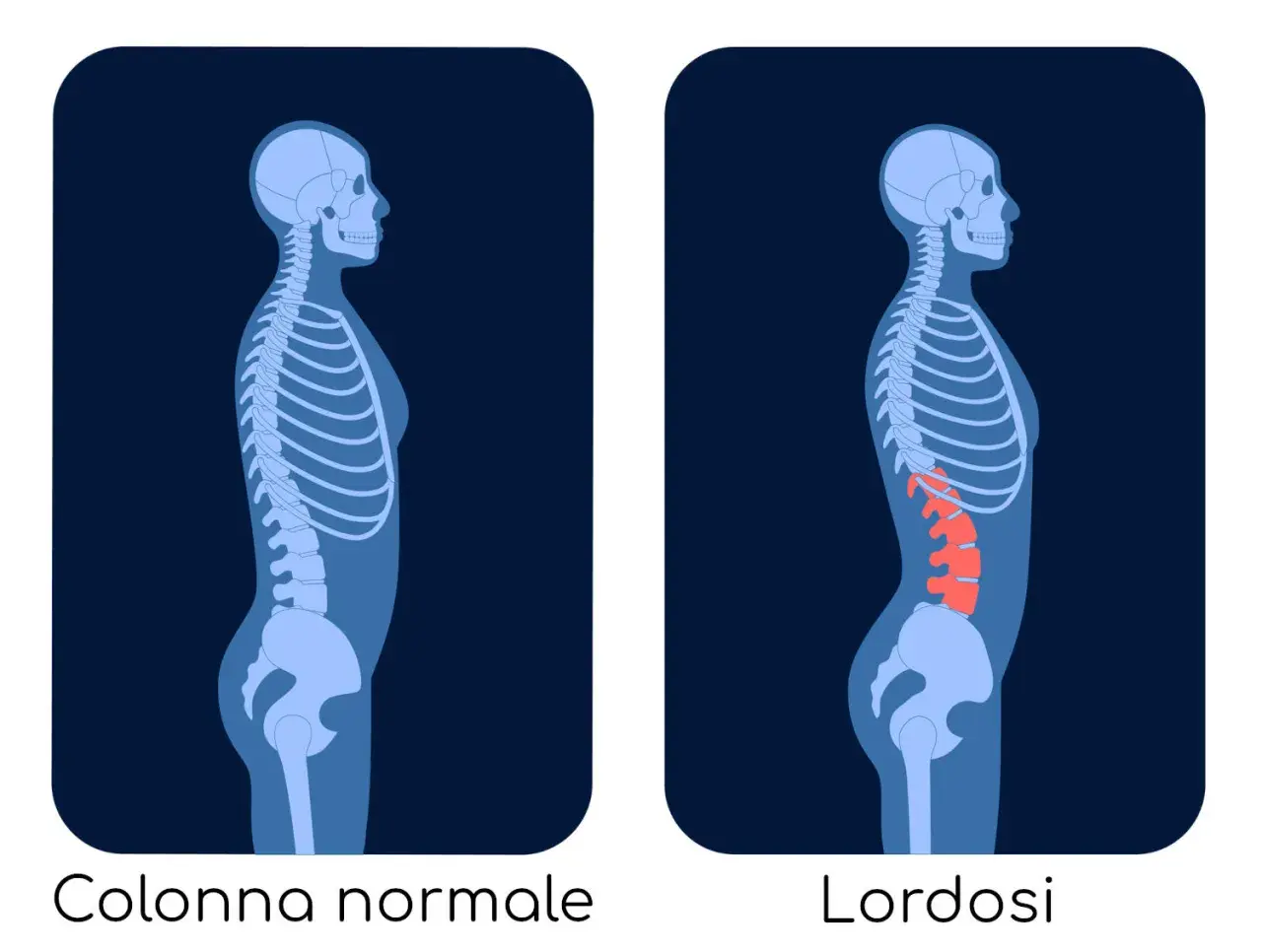 Confronto tra colonna vertebrale normale e lordosi. La lordosi cura è un percorso per correggere l'eccessiva curvatura lombare.