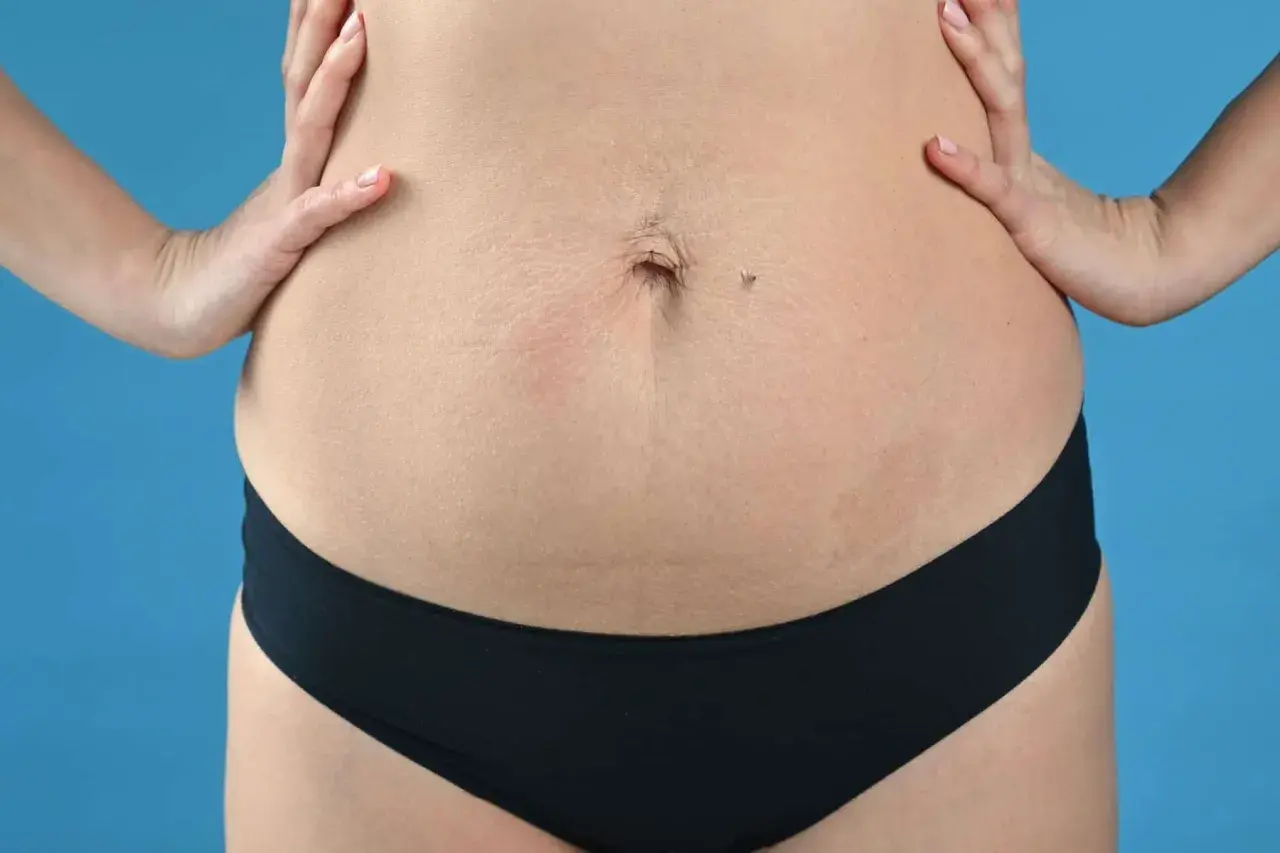Addome con smagliature, un ombelico e un neo. La tecnica Tupler può aiutare a migliorare l'aspetto.