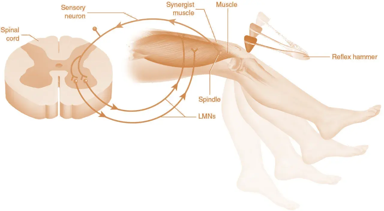 Schema del riflesso patellare: martelletto colpisce ginocchio, innescando un segnale nervoso che, passando per il midollo spinale, causa contrazione muscolare e movimento della gamba, evidenziando l'ipertono muscolare.