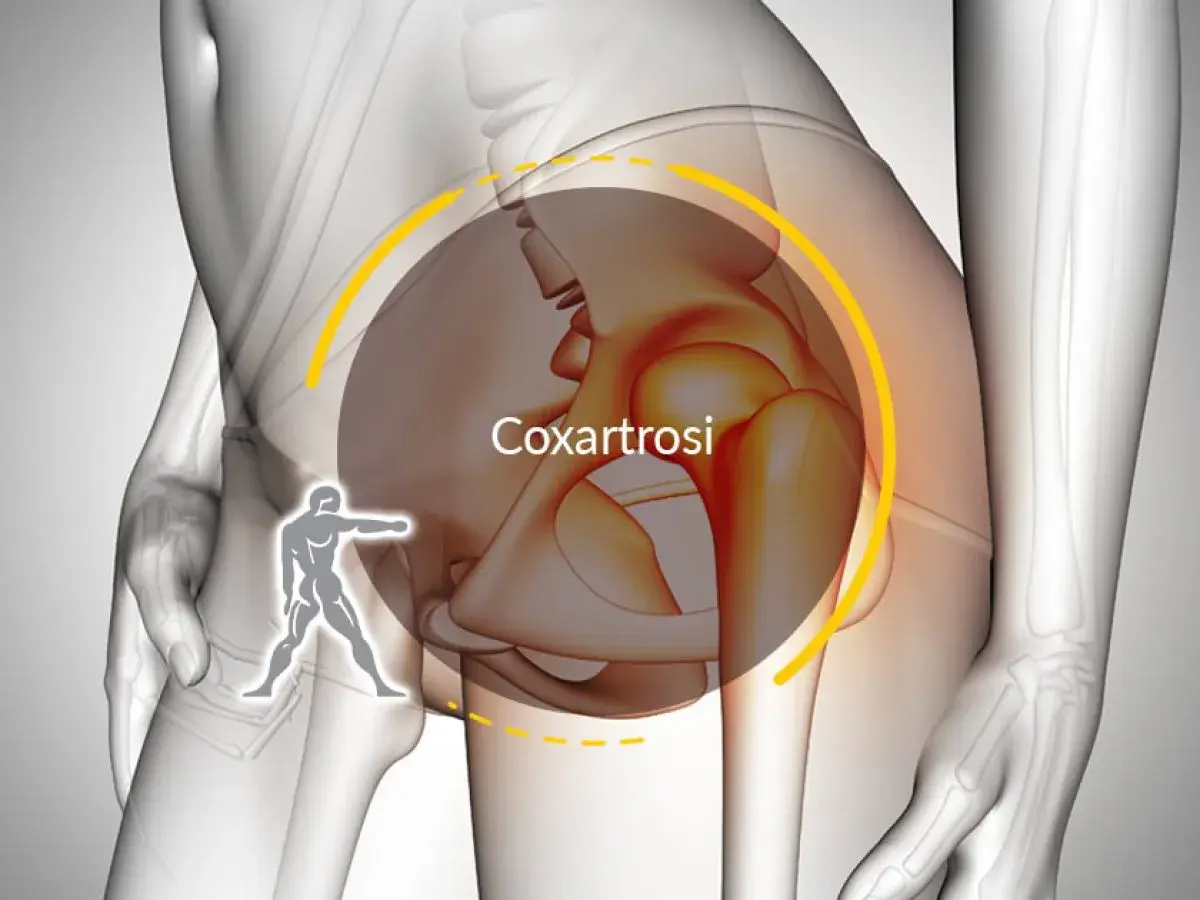Illustrazione anatomica dell'anca con la scritta "Coxartrosi". Un omino stilizzato indica la zona dolente, suggerendo che si guarisce da coxalgia.