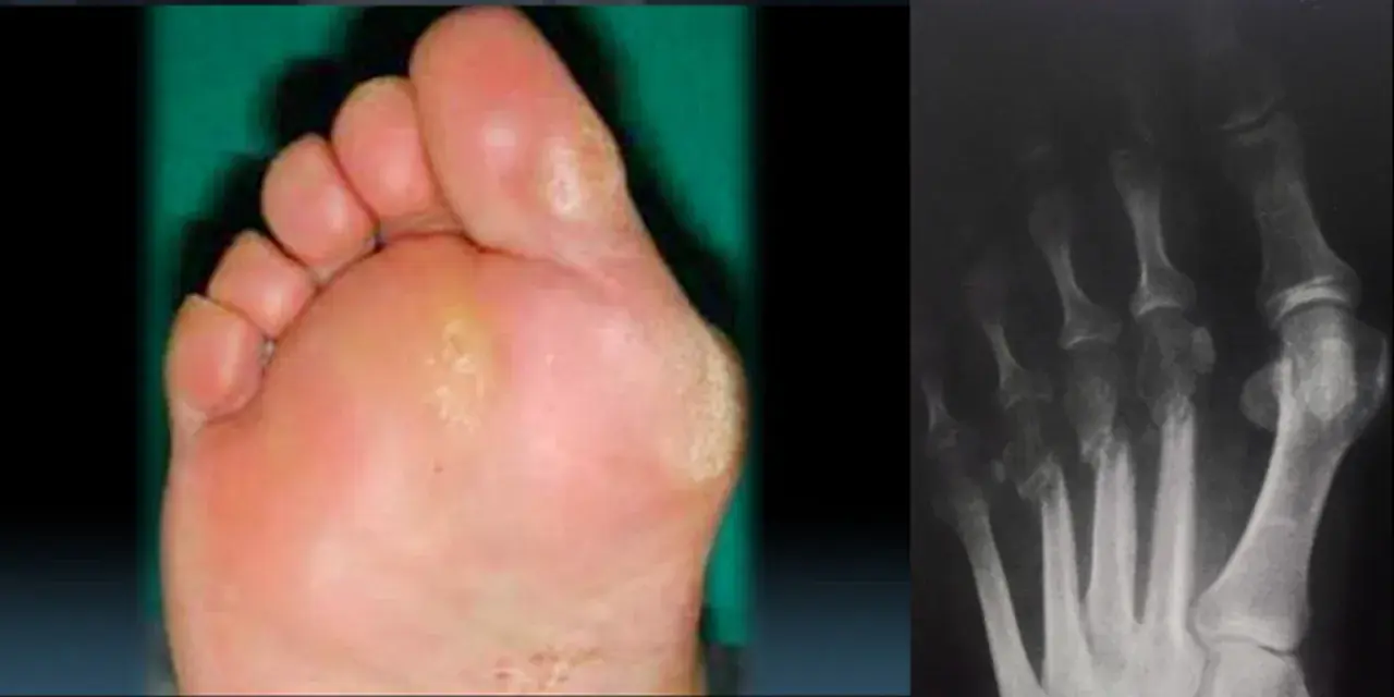 Piede con callosità e radiografia delle ossa metatarsali, possibili cause di metatarsalgia.