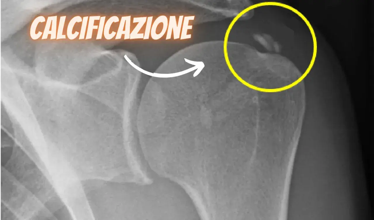 Radiografia spalla: calcificazioni evidenziate in giallo, indicative di tendinopatia calcifica.