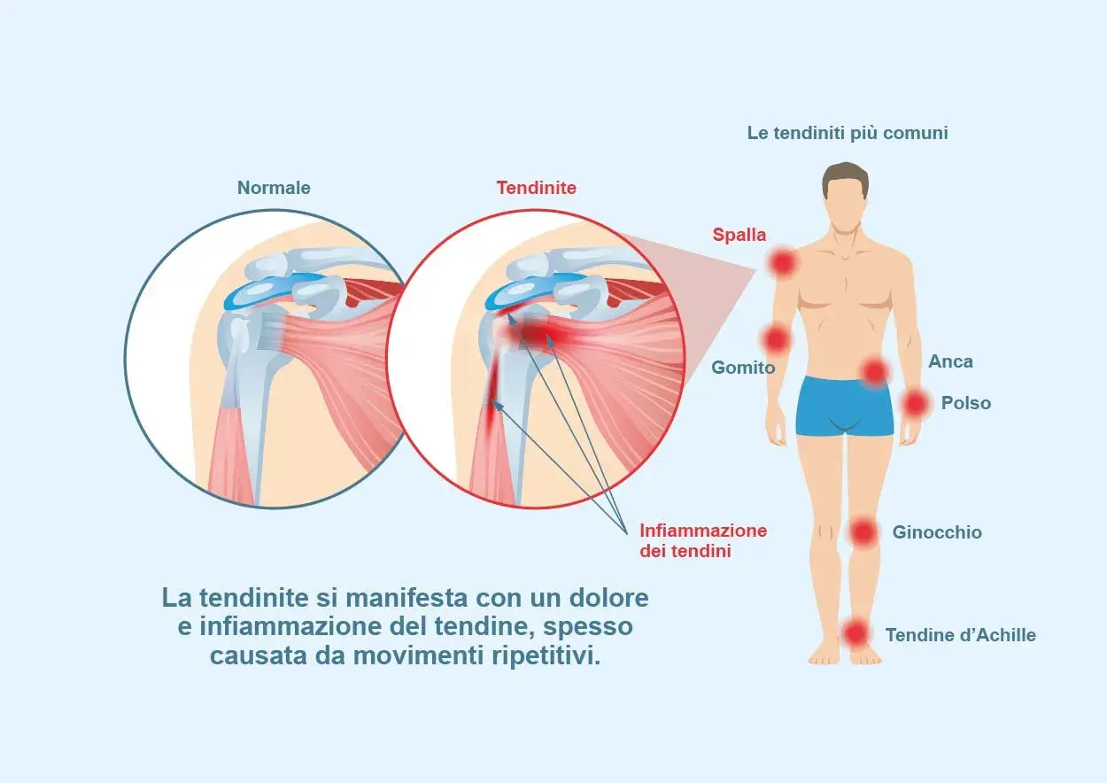 Illustrazione che mostra la differenza tra un tendine normale e uno infiammato, evidenziando le zone più colpite dalla tendinite e come si cura.
