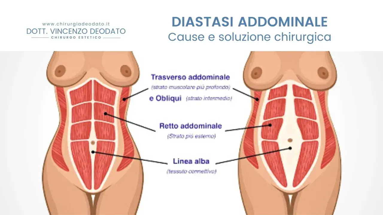 Illustrazione anatomica addominale che mostra la diastasi addominale, una condizione che può peggiorare se non trattata.