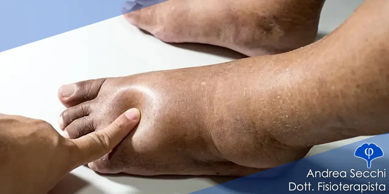 Piede gonfio con evidente imbibizione edematosa, segno di accumulo di liquidi.