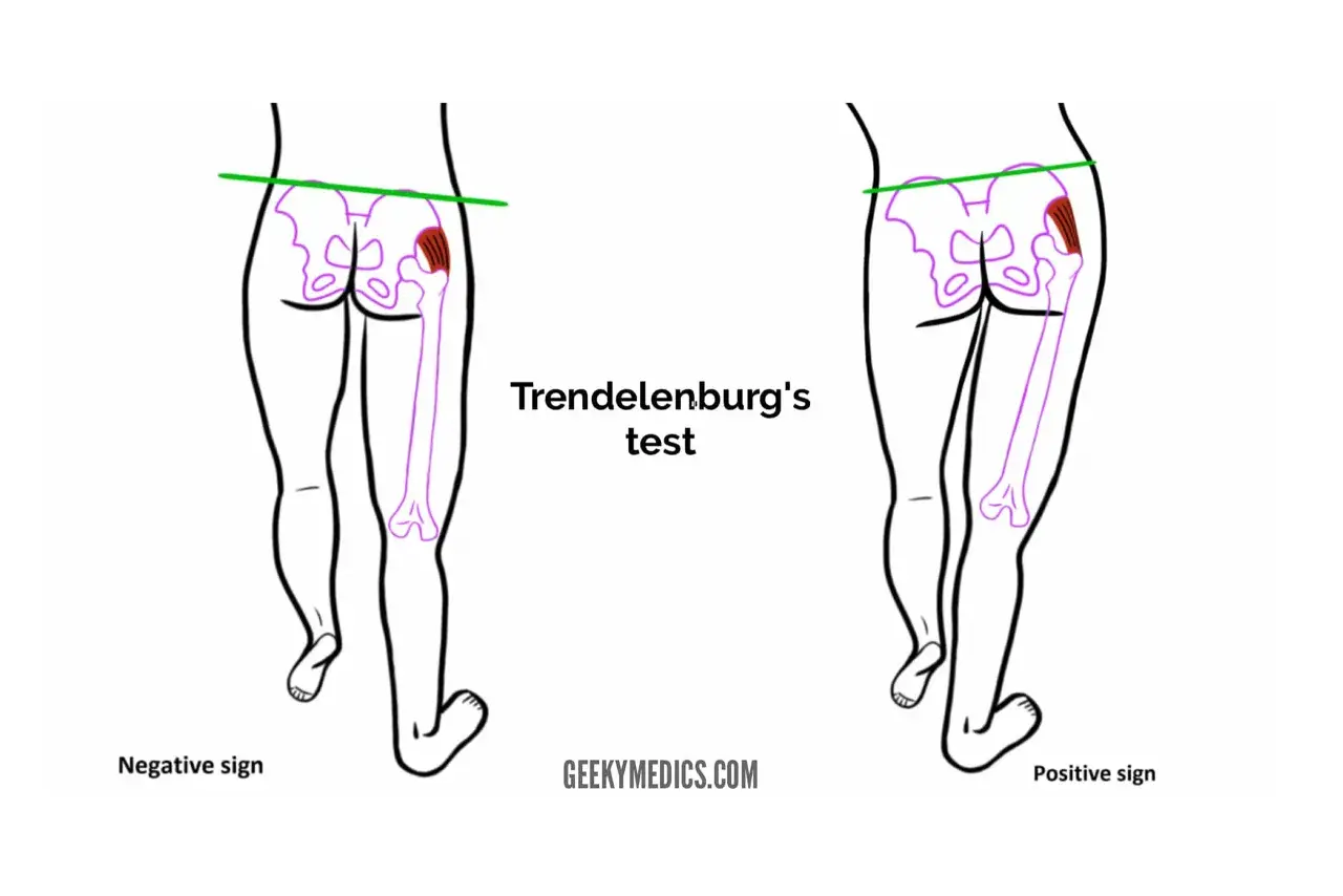 Illustrazione del test di Trendelenburg: bacino livellato (negativo) vs. bacino inclinato (positivo), evidenziando la debolezza del gluteo medio.