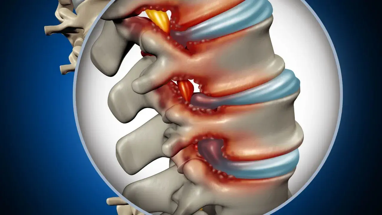 Dettaglio anatomico della colonna vertebrale lombare con infiammazione e compressione nervosa. Si può guarire da una stenosi lombare con le giuste cure.