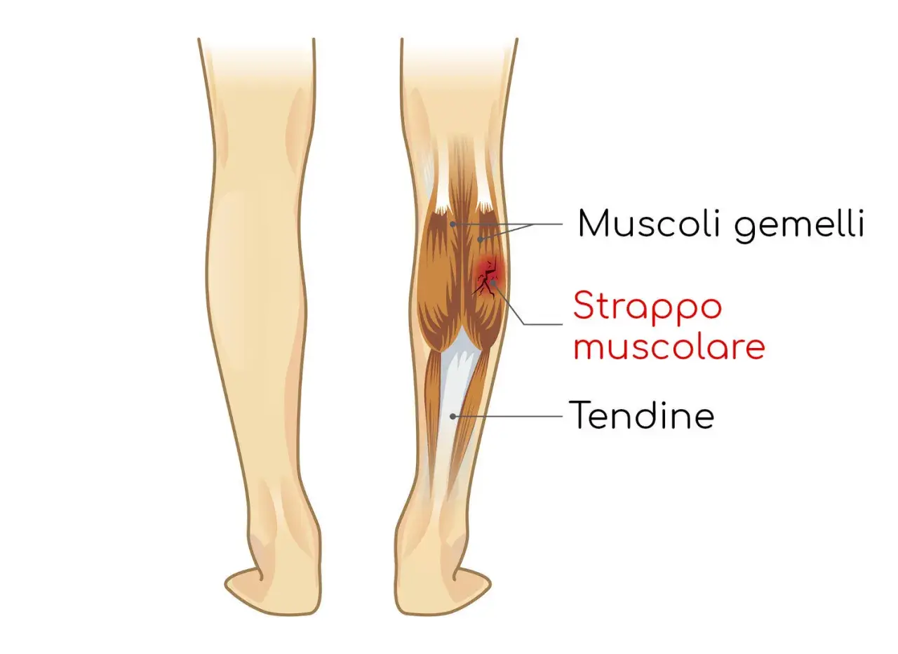 Illustrazione anatomica del polpaccio con strappo muscolare cicatrizzato male nei muscoli gemelli.