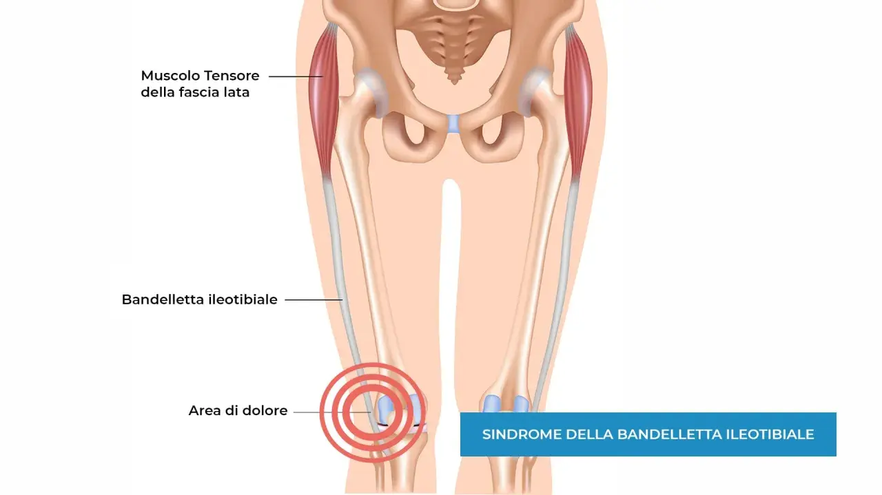 Illustrazione anatomica del ginocchio che mostra la bandelletta ileotibiale e l'area di dolore, indicando la sindrome della bandelletta ileotibiale che non guarisce.
