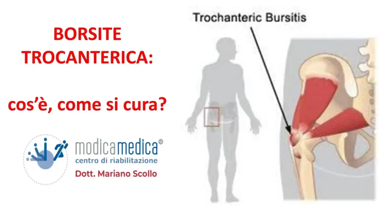 Illustrazione anatomica della borsite trocanterica, con indicazione della zona interessata e del centro di riabilitazione Modicamedica.