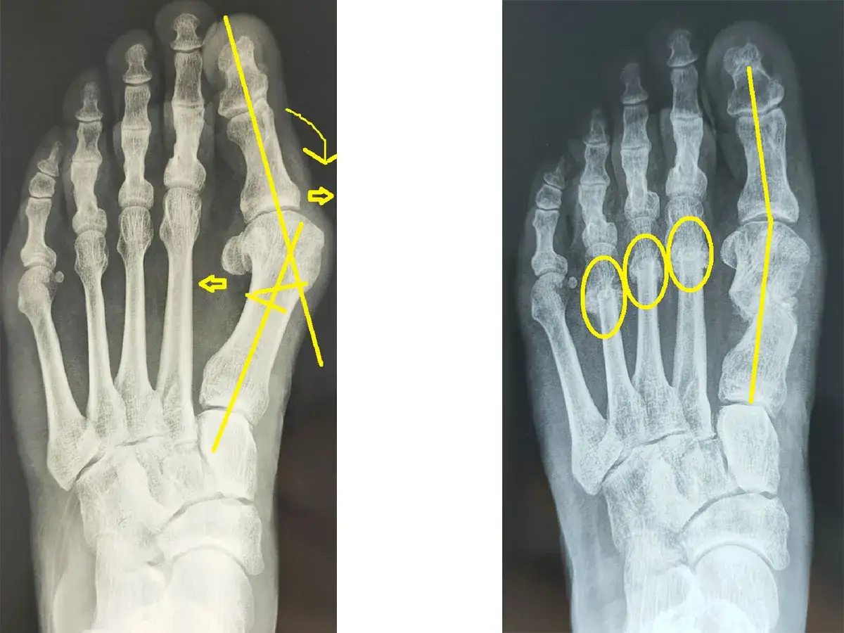 Radiografie del piede che mostrano un alluce valgo con frecce e cerchi gialli che evidenziano la deformit&agrave; e le aree di interesse.