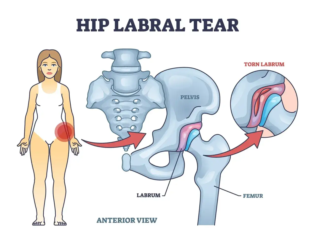 Illustrazione anatomica del conflitto femoro-acetabolare, con focus sui sintomi e sul labbro lesionato dell'anca.