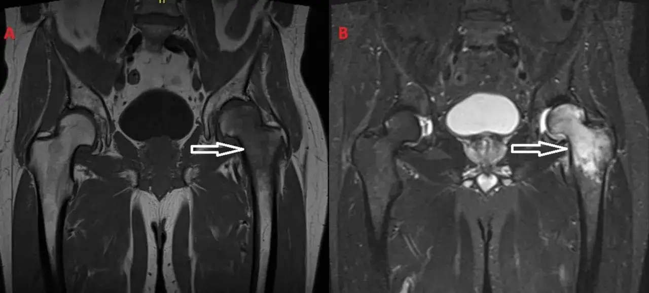 Risonanza magnetica delle anche: immagine A mostra edema osseo nel femore sinistro, immagine B evidenzia edema osseo nel femore destro.