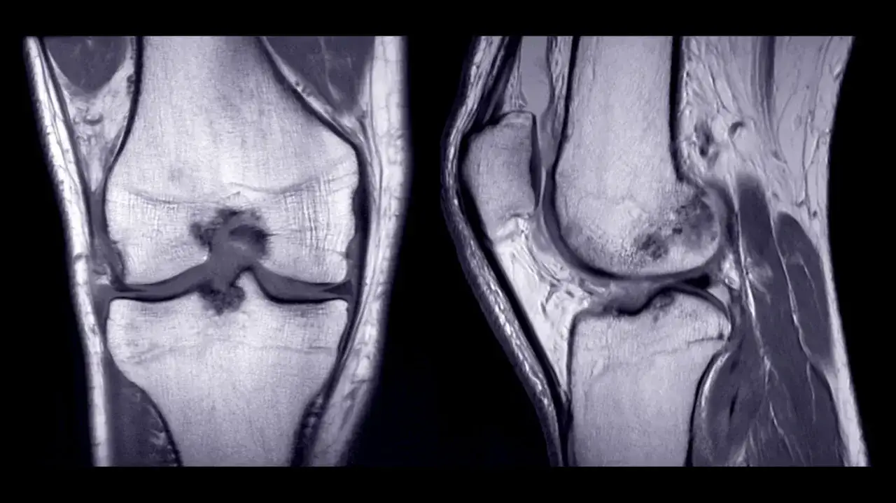 Risonanza magnetica del ginocchio che mostra edema osseo, un sintomo comune di lesioni o infiammazioni.