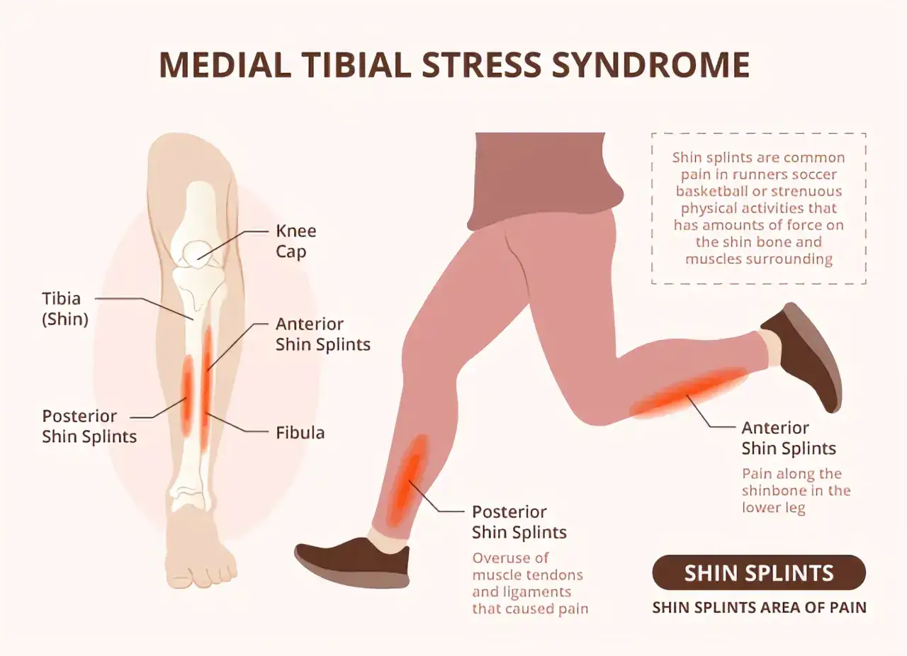 Illustrazione anatomica che mostra la fascite della gamba (shin splints), con aree di dolore evidenziate sulla tibia.