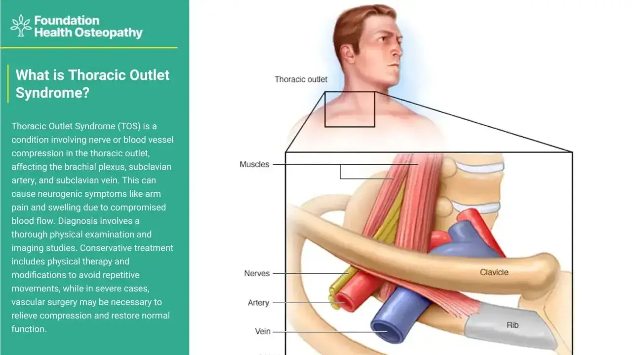 Illustrazione anatomica del test per la sindrome dello stretto toracico, che mostra la compressione di nervi e vasi sanguigni.
