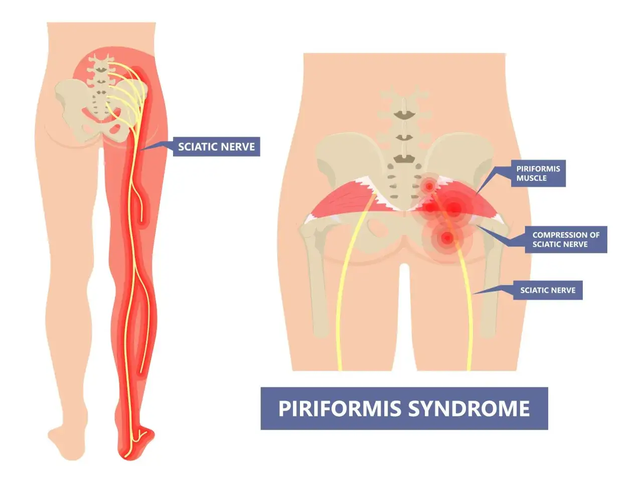 Illustrazione della sindrome del piriforme: il muscolo piriforme infiammato comprime il nervo sciatico, causando dolore lungo la gamba.