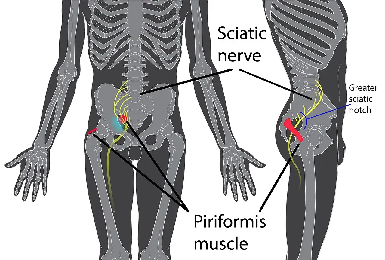 Diagramma anatomico che mostra il nervo sciatico e il muscolo piriforme. Il piriforme infiammato quanto dura &egrave; una domanda comune per chi soffre di sciatica.