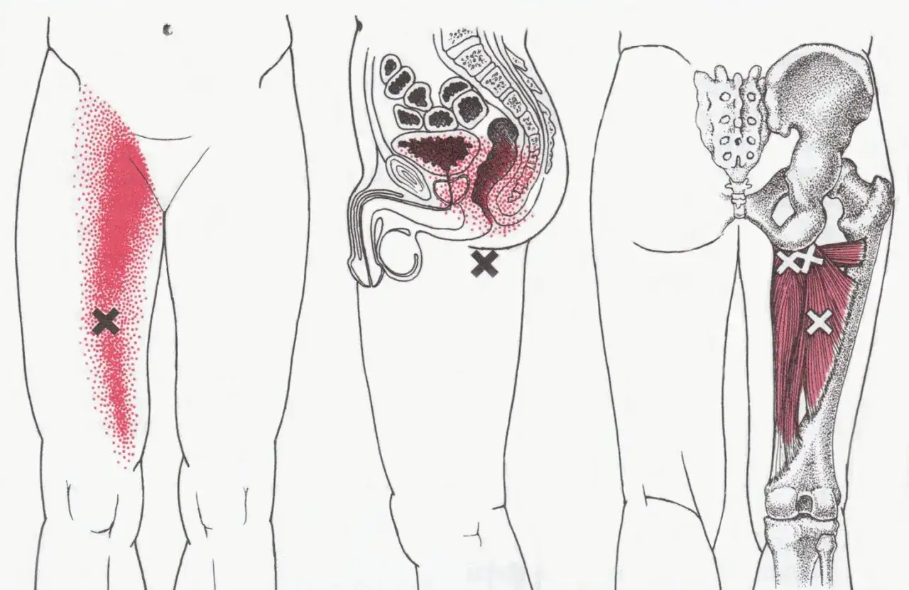 Illustrazione anatomica che mostra aree di dolore riferito, inclusa la sinfisi pubica, con punti rossi che indicano zone dolenti e croci che segnano i trigger point.