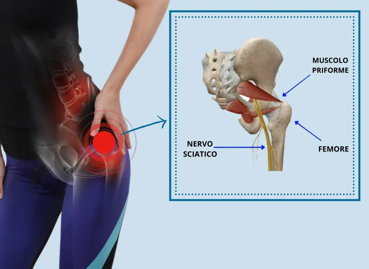 Dolore all'anca evidenziato, con ingrandimento anatomico del muscolo piriforme e nervo sciatico.