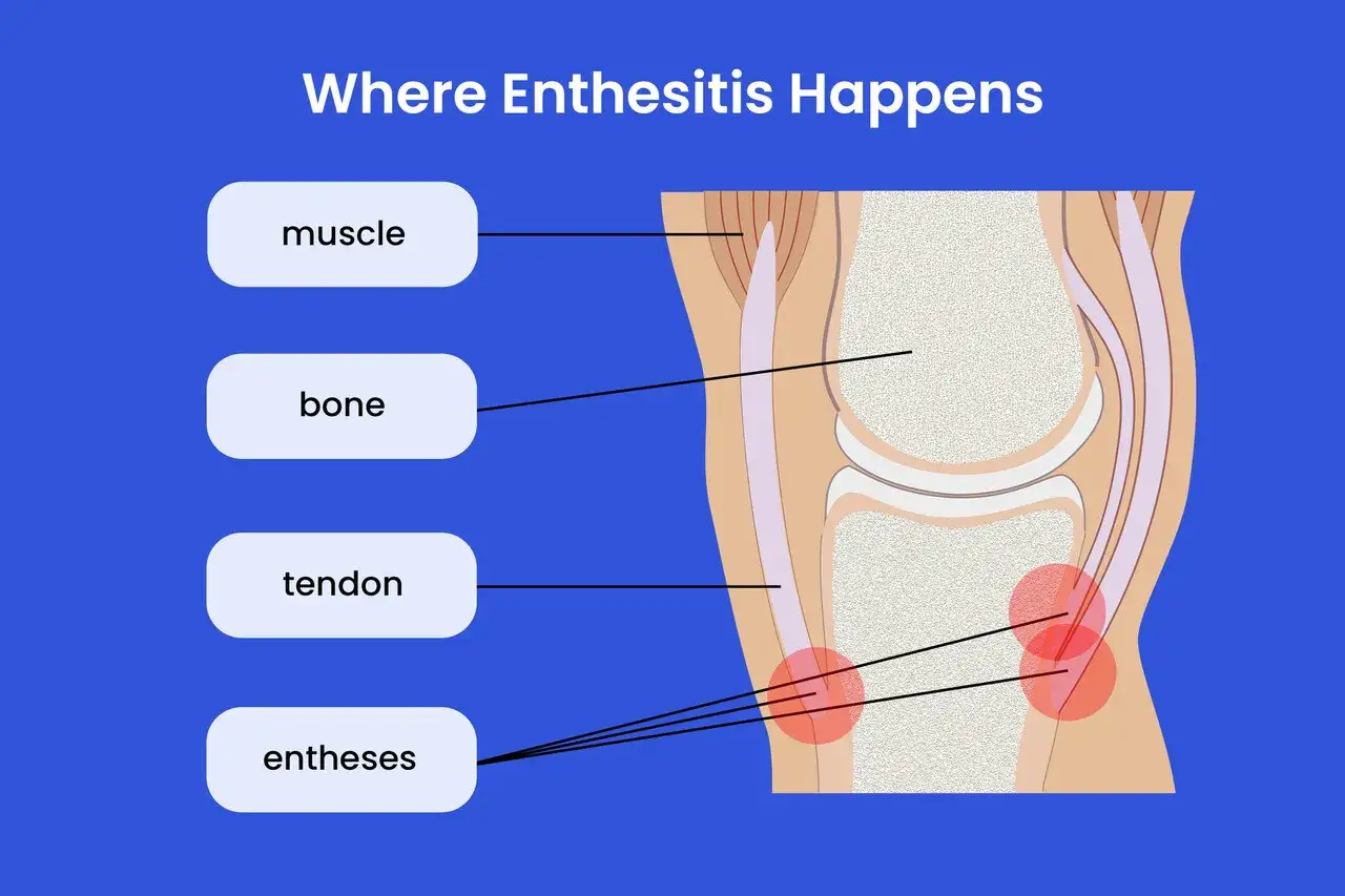 Illustrazione del ginocchio che mostra dove si verifica l'entesite: muscolo, osso, tendine e entesi.