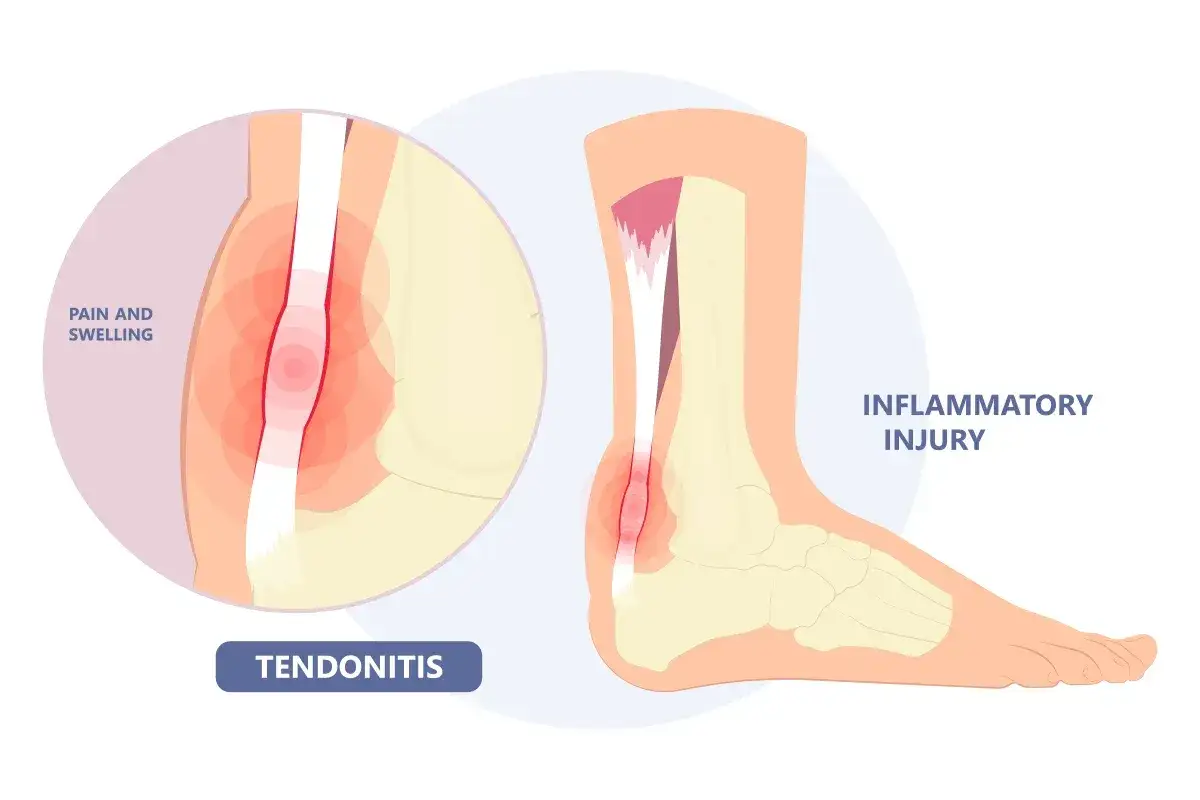 Illustrazione anatomica che mostra cos'&egrave; la tendinite, con un ingrandimento che evidenzia dolore e gonfiore in un tendine infiammato.