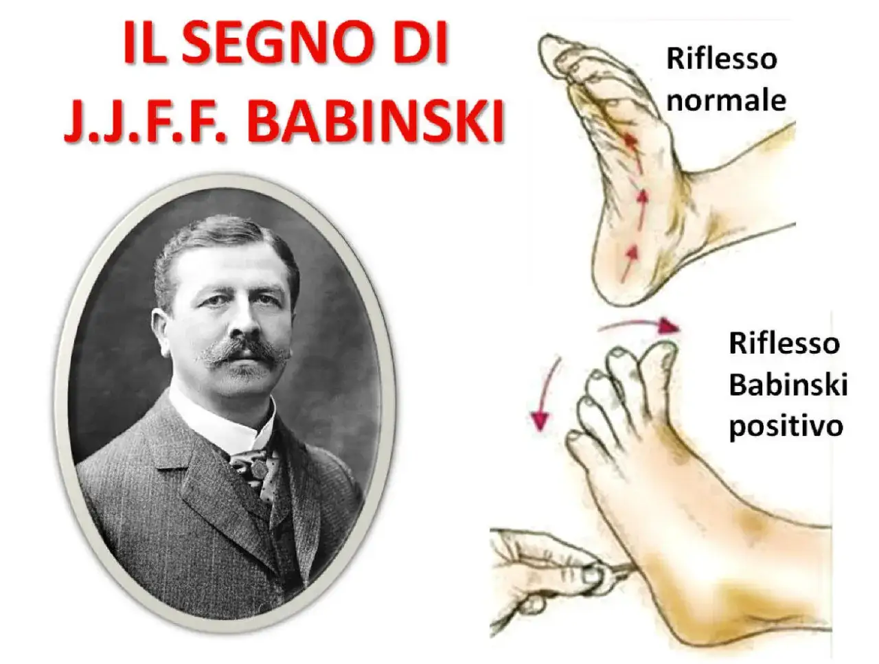 Ritratto di J.J.F. Babinski accanto a illustrazioni del riflesso normale e del riflesso Babinski positivo.
