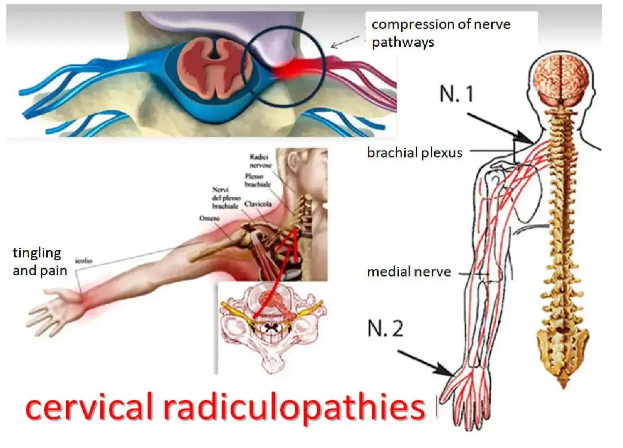 Illustrazione della radicolopatia cervicale: compressione nervosa al collo causa formicolio e dolore al braccio.