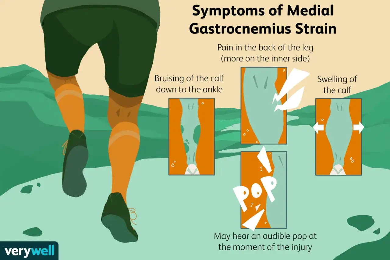 Dolore al polpaccio, non riesco a camminare. L'immagine illustra i sintomi di uno strappo al polpaccio, con dolore, lividi e gonfiore.
