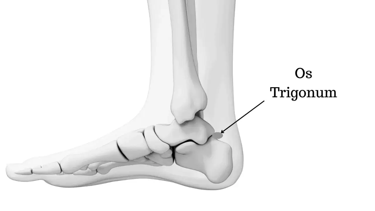 Illustrazione anatomica del piede che evidenzia l'osso accessorio os trigonum, una piccola formazione ossea dietro il tallone.