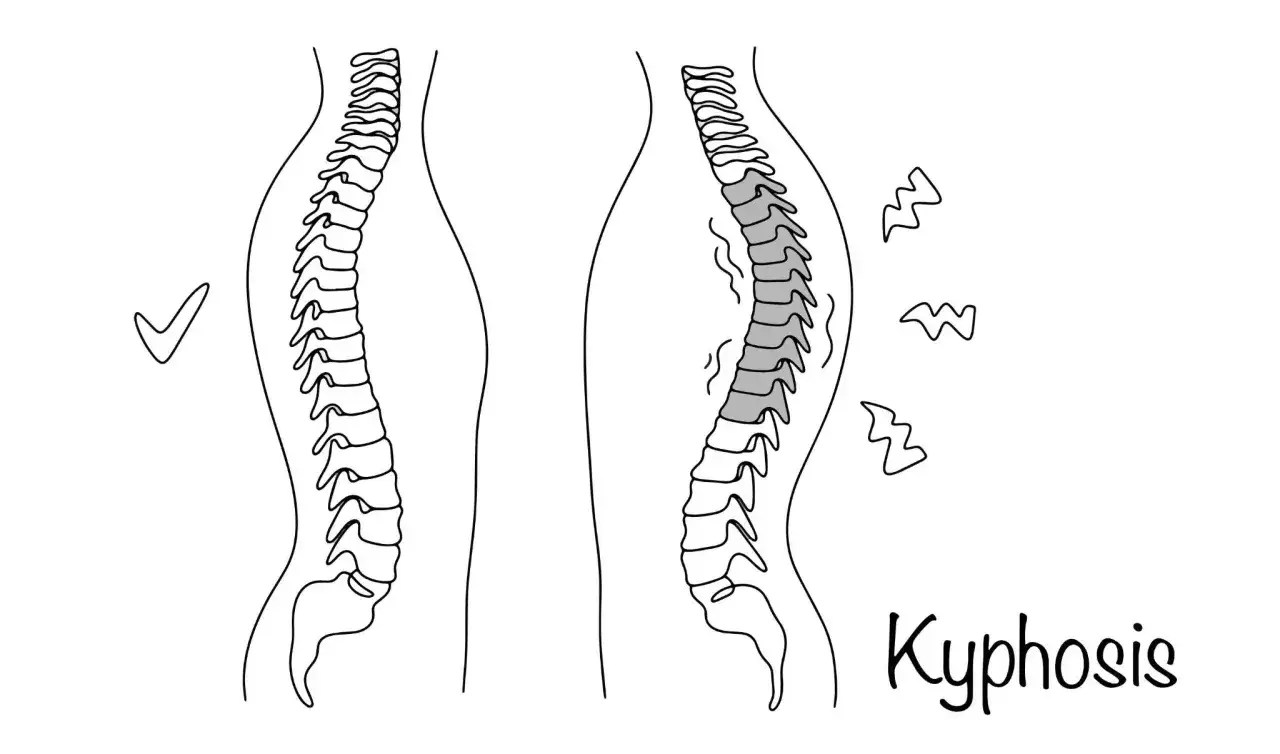 Schiena sana a sinistra, con un segno di spunta. A destra, la colonna vertebrale mostra una curvatura accentuata, indicando cifosi toracica.