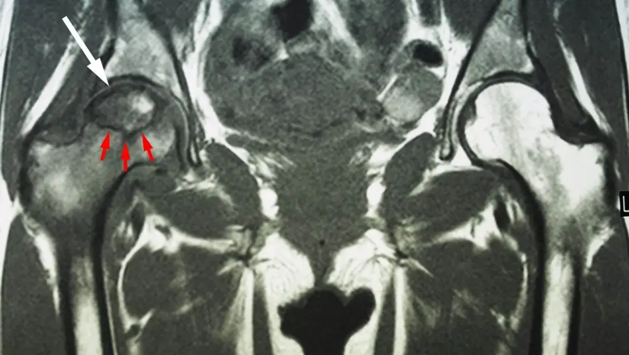 Risonanza magnetica delle anche: la freccia bianca indica la testa del femore, le rosse evidenziano aree di necrosi.