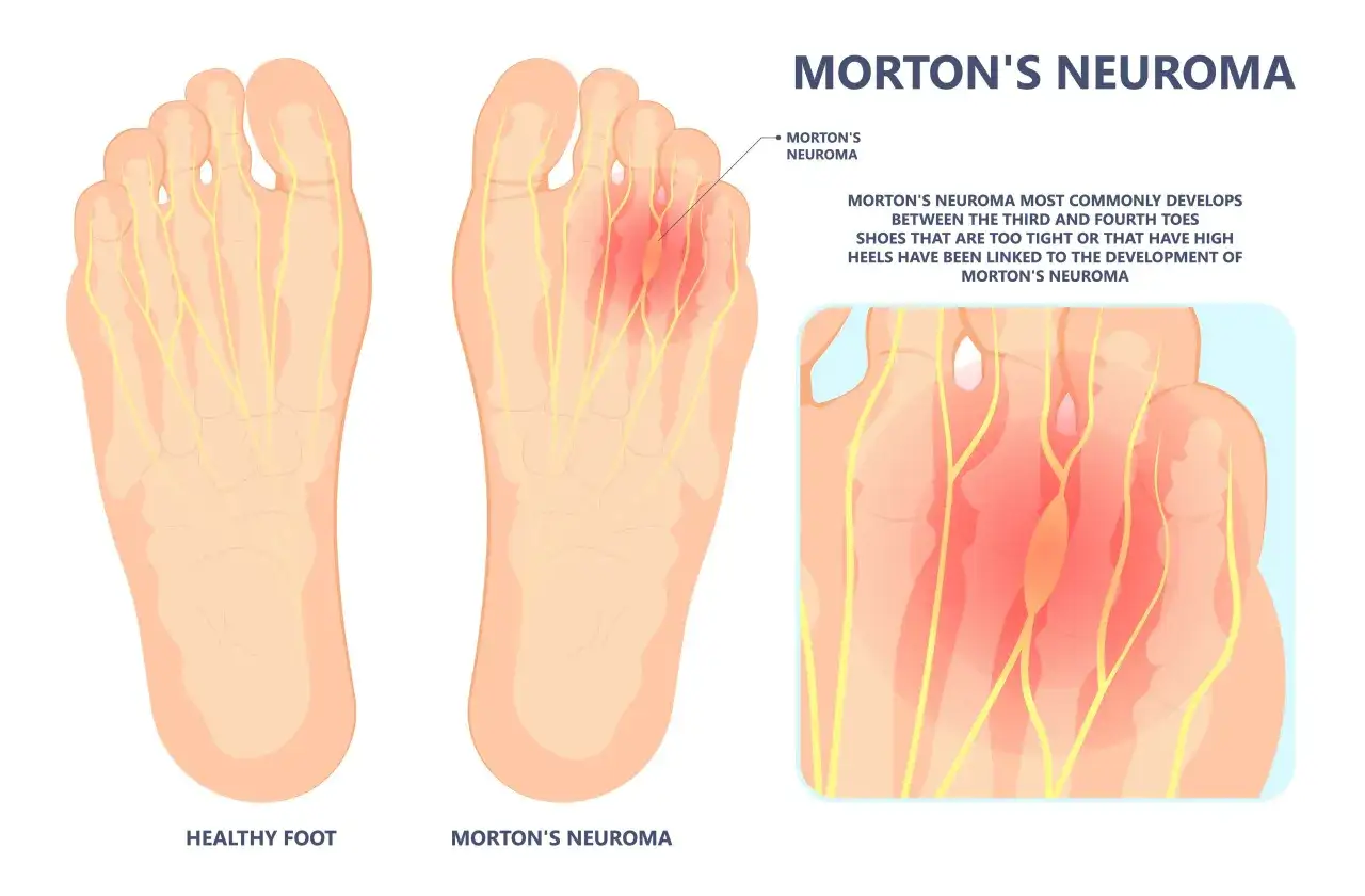Piede sano a sinistra, piede con neuroma di Morton tra terzo e quarto dito a destra. Il neuroma di Morton &egrave; un ispessimento del tessuto nervoso.