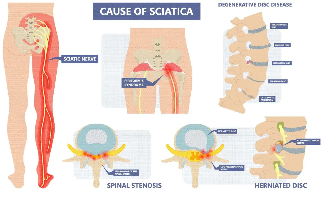 Illustrazione delle cause della sciatica, inclusa l'ernia al disco, con possibili rimedi.