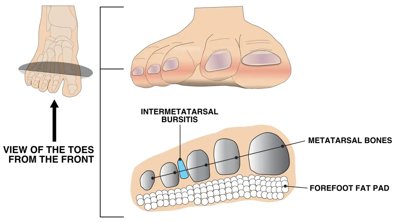 Illustrazione anatomica del piede che mostra la metatarsalgia, con enfasi sull'intermetatarsale borsite come possibile causa.