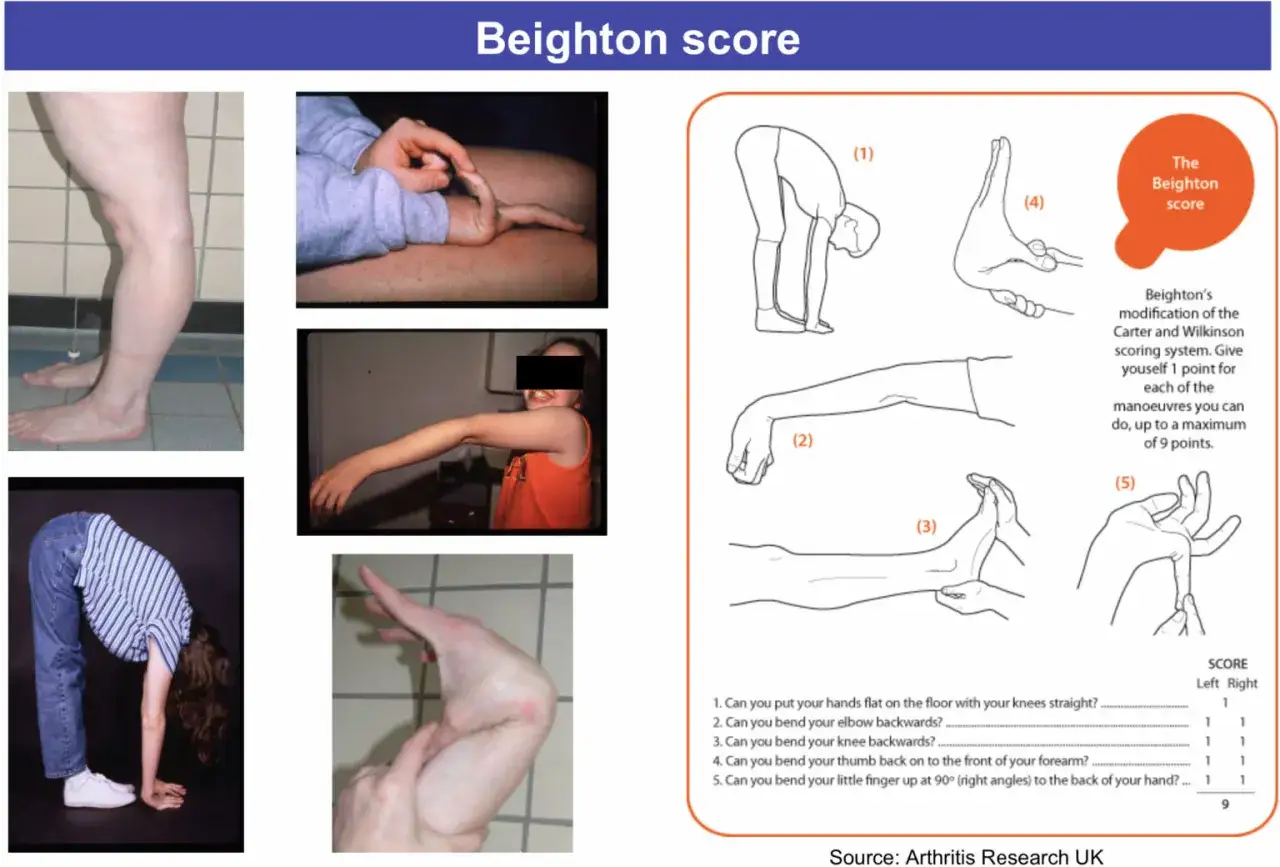 Valutazione dell'iperlassit&agrave; articolare con il Beighton score. Immagini mostrano flessibilit&agrave; di gambe, braccia e dita.