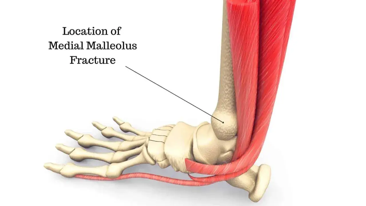 Illustrazione anatomica che mostra la posizione di una frattura del malleolo mediale, evidenziando i tendini della caviglia interna.